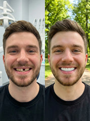 Teeth Coverings | Clip On Veneers