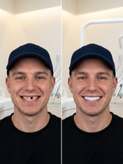 Teeth Coverings | Clip On Veneers